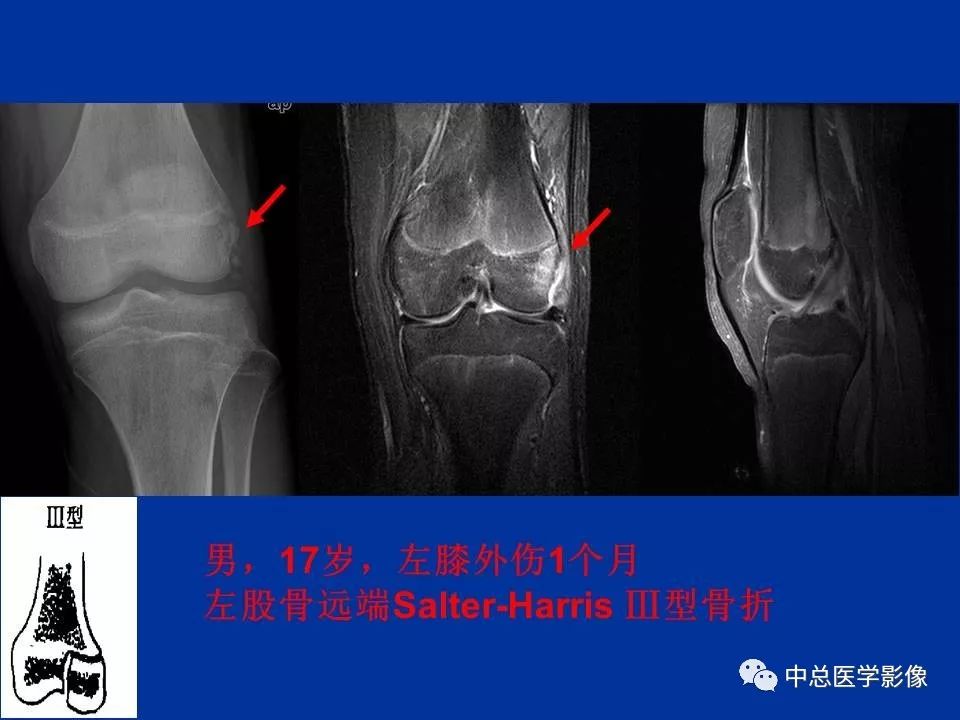 影像PPT - 【PPT】骨骺软骨损伤MR诊断-20