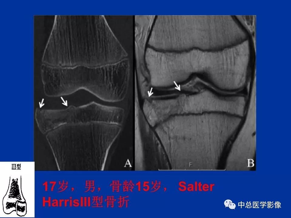 影像PPT - 【PPT】骨骺软骨损伤MR诊断-21