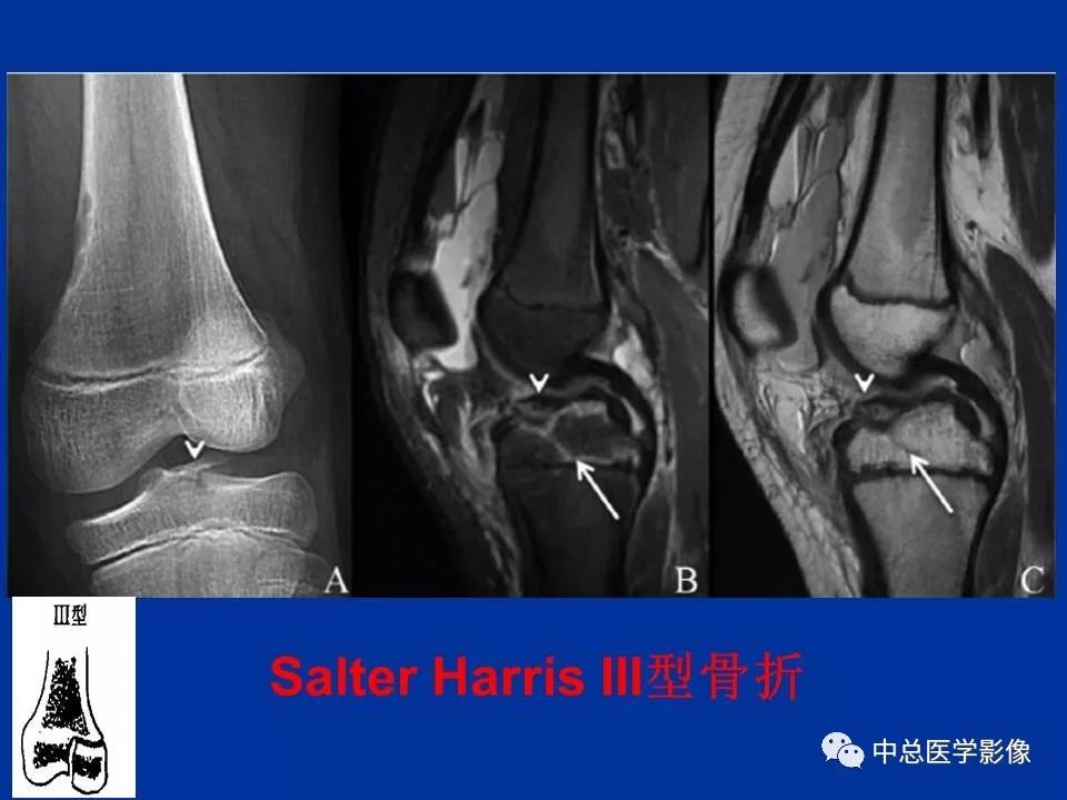 影像PPT - 【PPT】骨骺软骨损伤MR诊断-22
