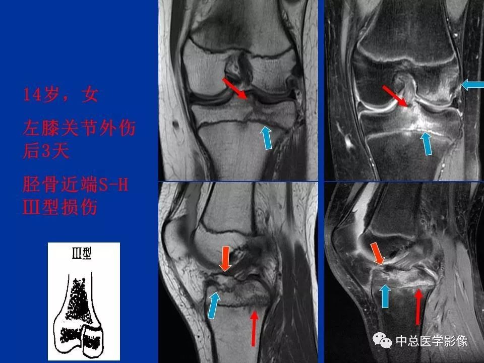 影像PPT - 【PPT】骨骺软骨损伤MR诊断-23