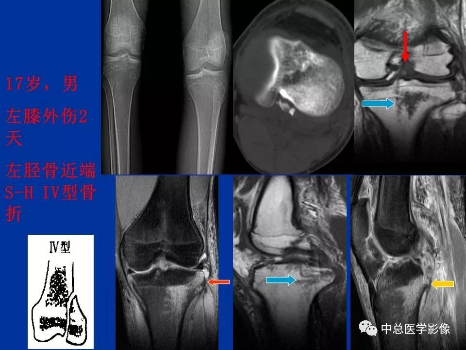 影像PPT - 【PPT】骨骺软骨损伤MR诊断-24