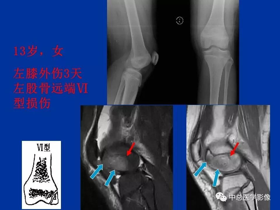 影像PPT - 【PPT】骨骺软骨损伤MR诊断-25