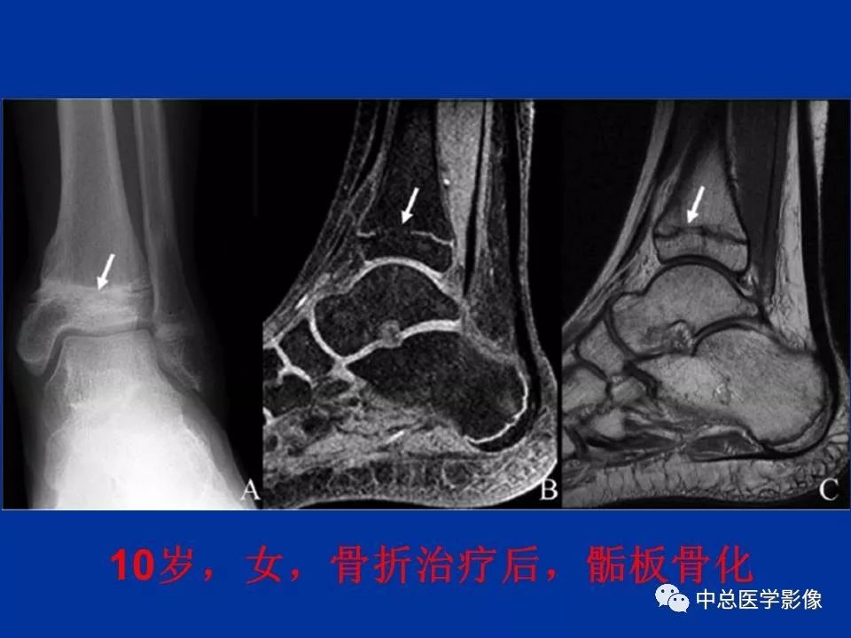 影像PPT - 【PPT】骨骺软骨损伤MR诊断-26