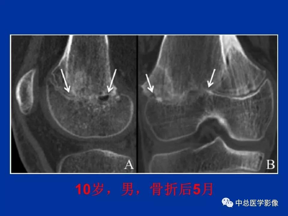 影像PPT - 【PPT】骨骺软骨损伤MR诊断-27