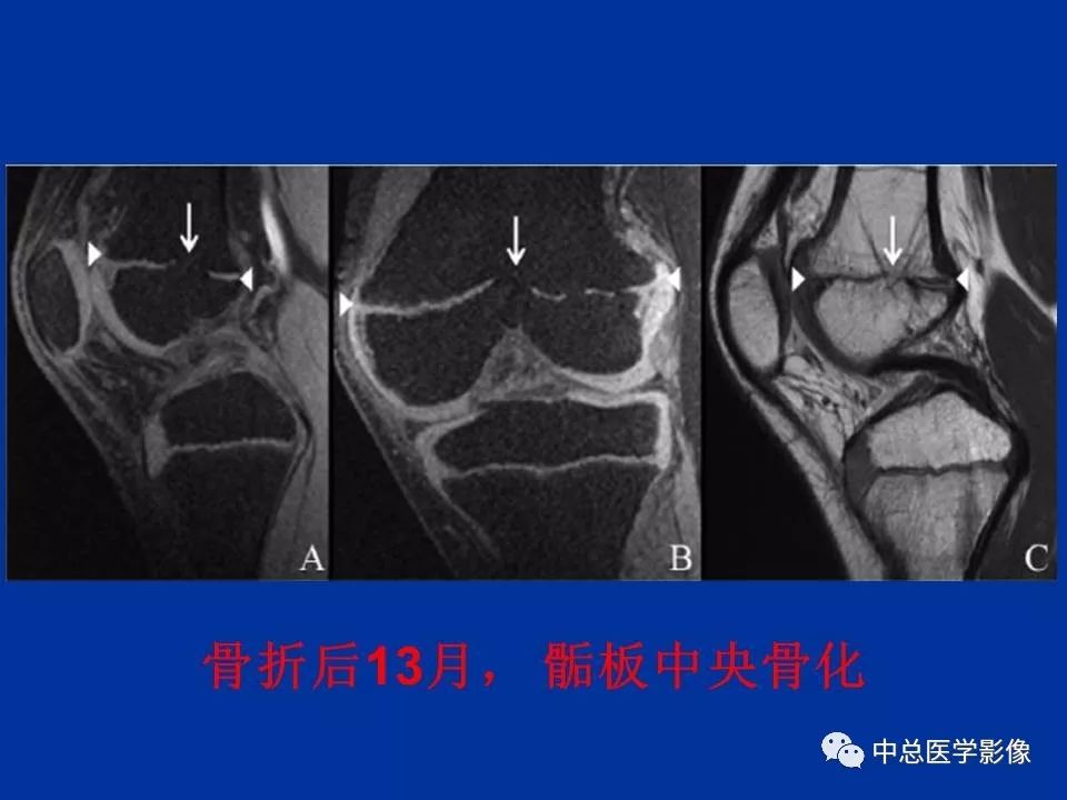 影像PPT - 【PPT】骨骺软骨损伤MR诊断-28