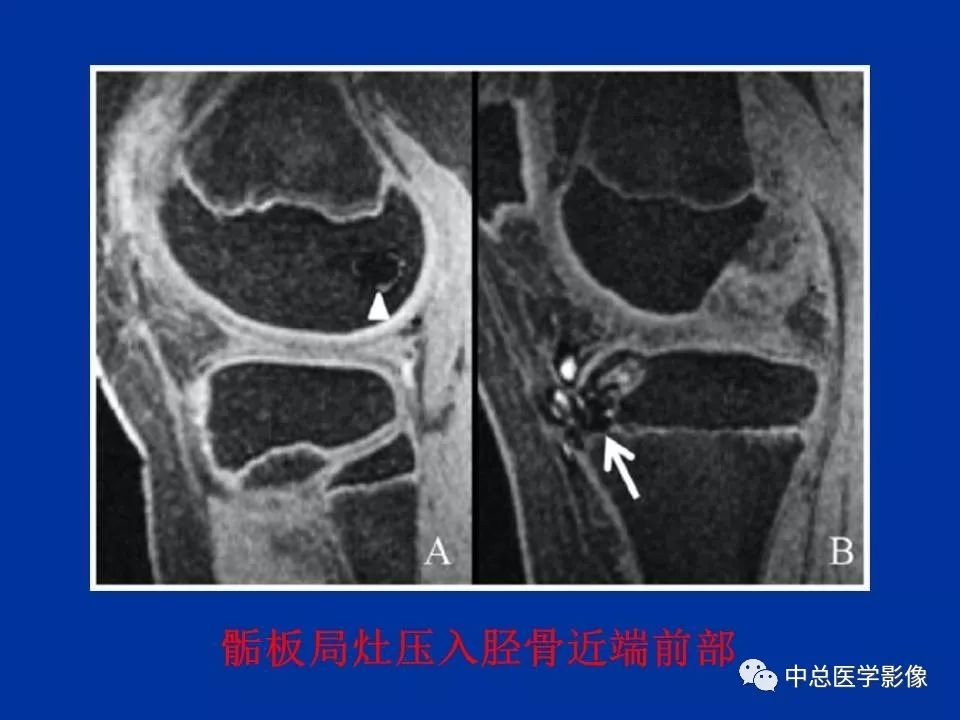 影像PPT - 【PPT】骨骺软骨损伤MR诊断-30