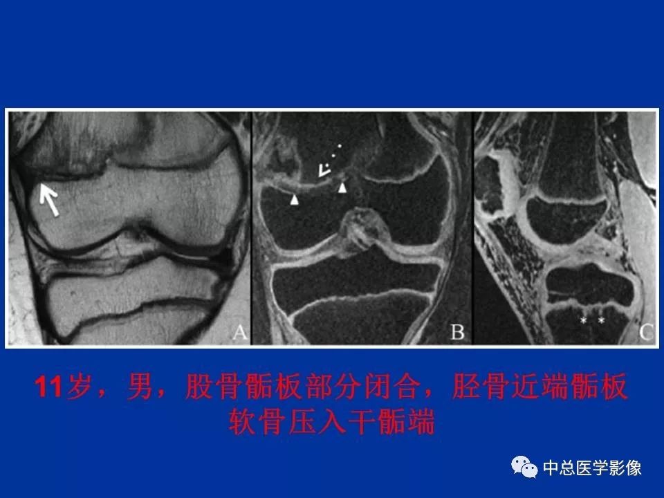 影像PPT - 【PPT】骨骺软骨损伤MR诊断-29