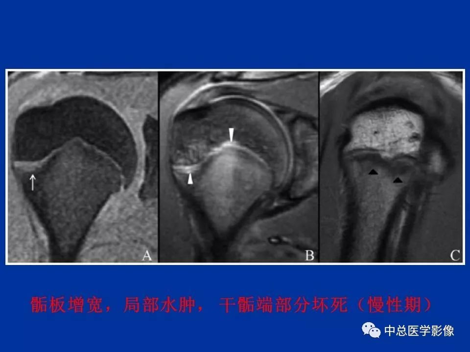 影像PPT - 【PPT】骨骺软骨损伤MR诊断-31
