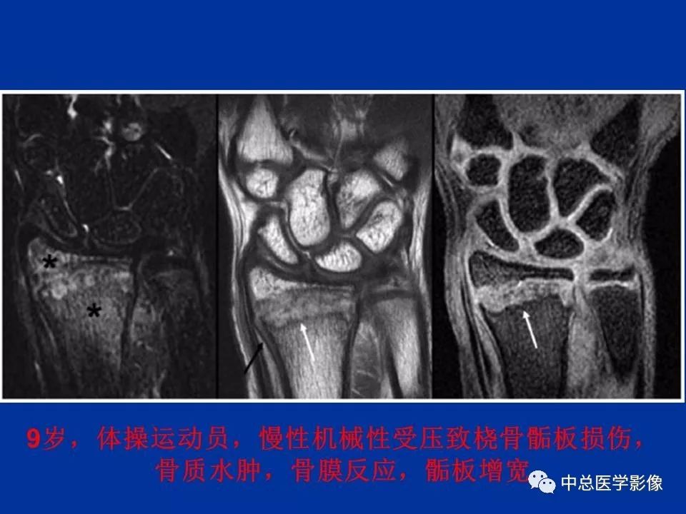 影像PPT - 【PPT】骨骺软骨损伤MR诊断-32