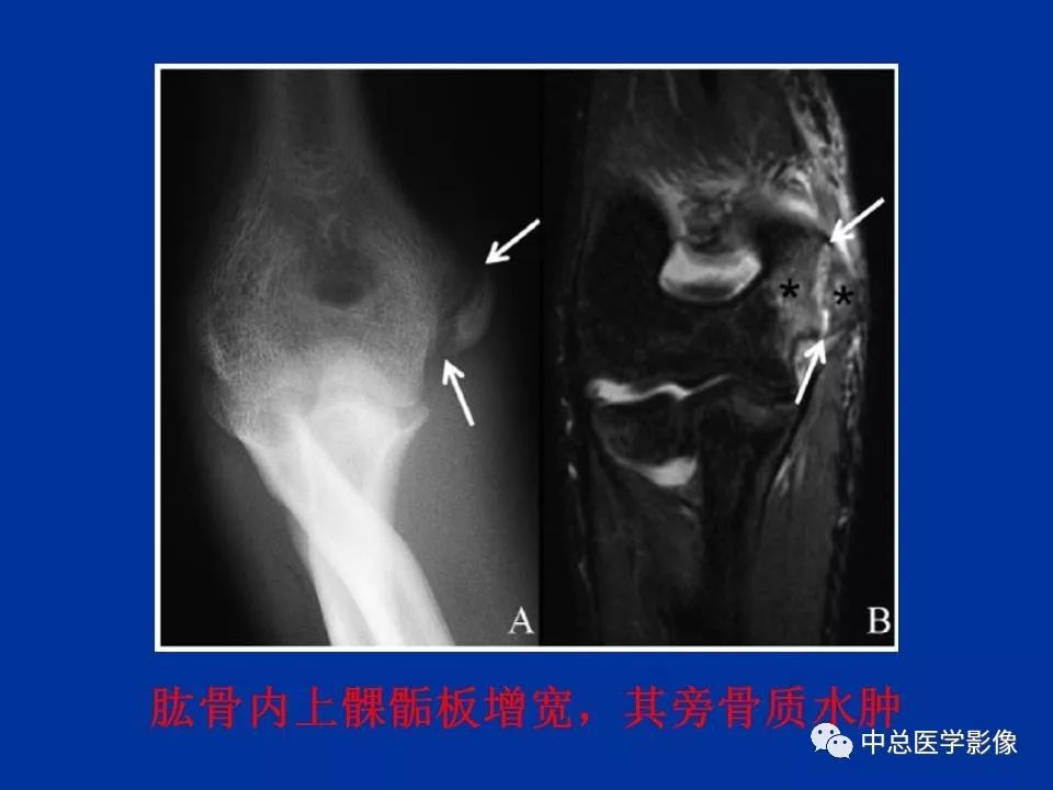 影像PPT - 【PPT】骨骺软骨损伤MR诊断-33
