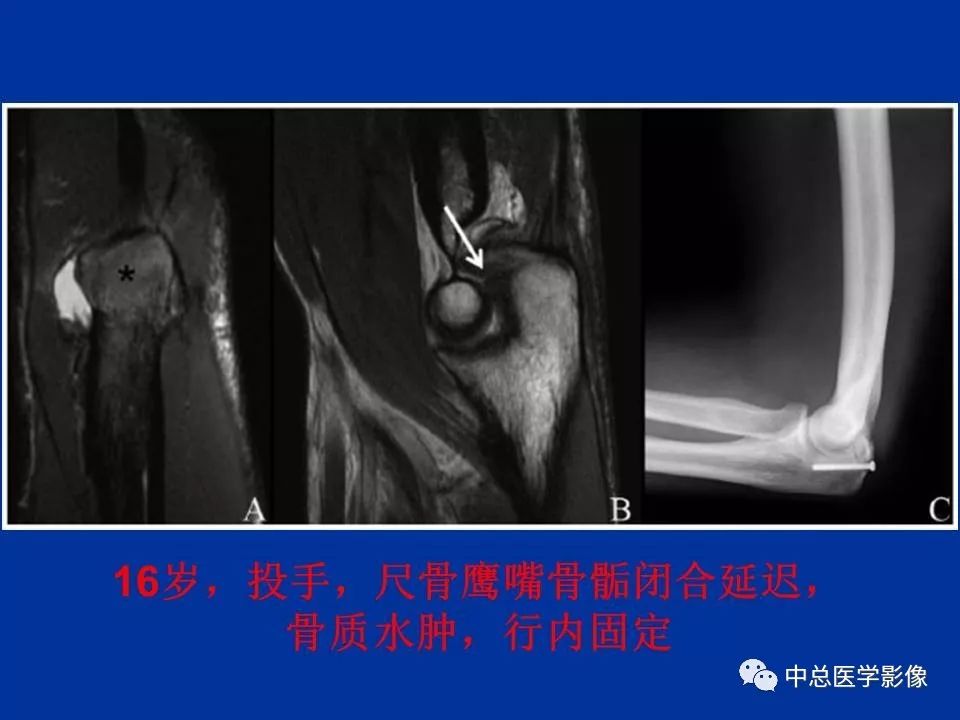 影像PPT - 【PPT】骨骺软骨损伤MR诊断-34