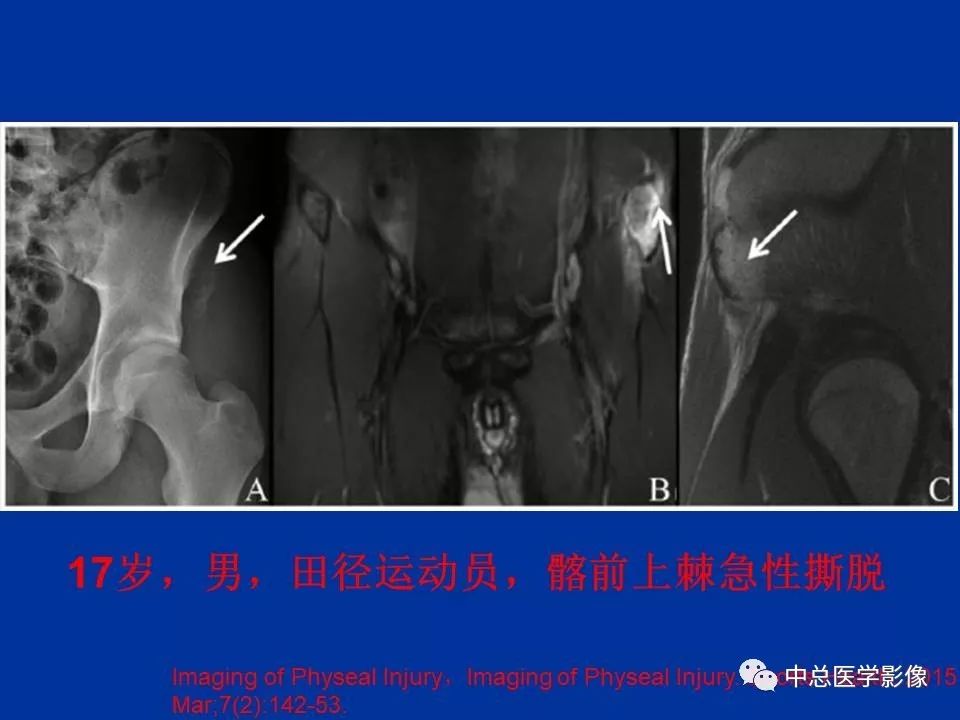 影像PPT - 【PPT】骨骺软骨损伤MR诊断-35