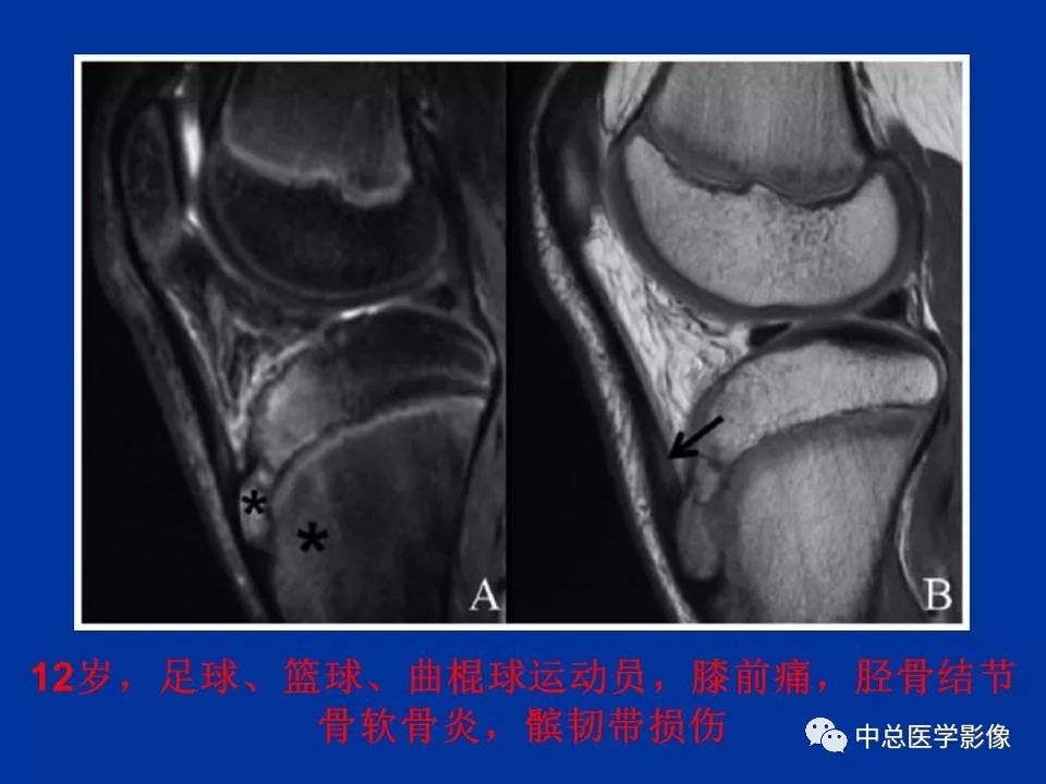 影像PPT - 【PPT】骨骺软骨损伤MR诊断-36