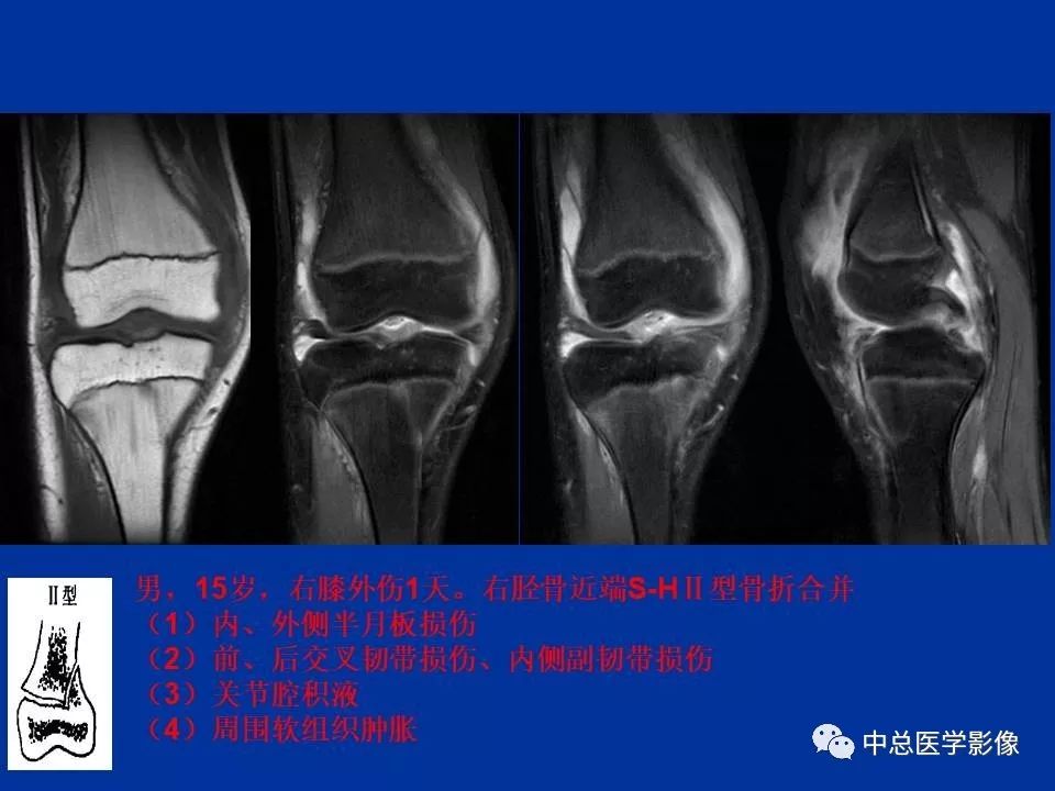 影像PPT - 【PPT】骨骺软骨损伤MR诊断-38