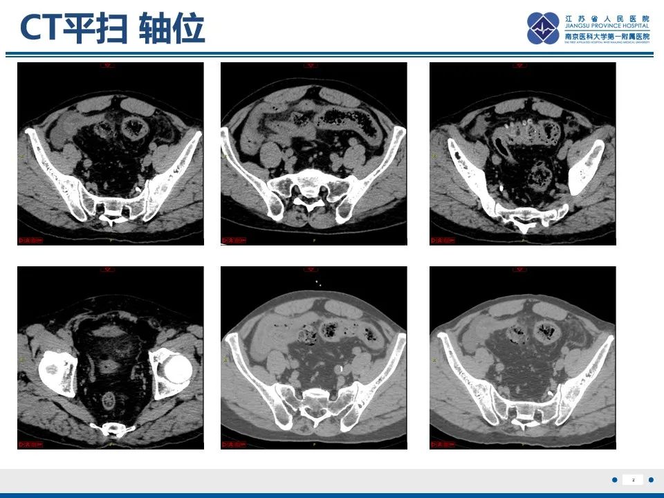 影像PPT - 【PPT】结肠憩室炎-3