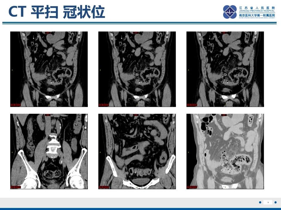 影像PPT - 【PPT】结肠憩室炎-4