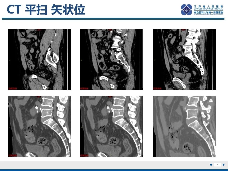影像PPT - 【PPT】结肠憩室炎-5