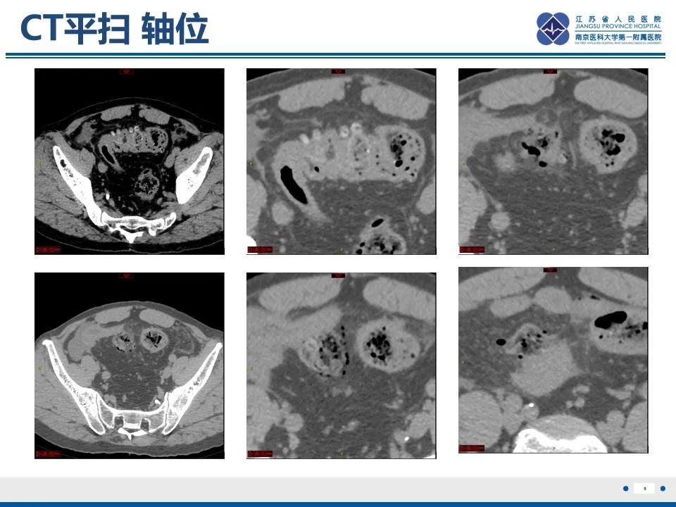 影像PPT - 【PPT】结肠憩室炎-6