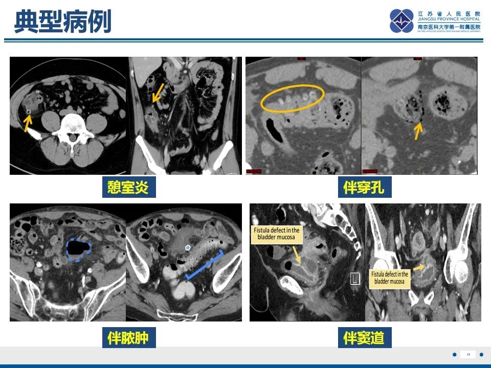 影像PPT - 【PPT】结肠憩室炎-18