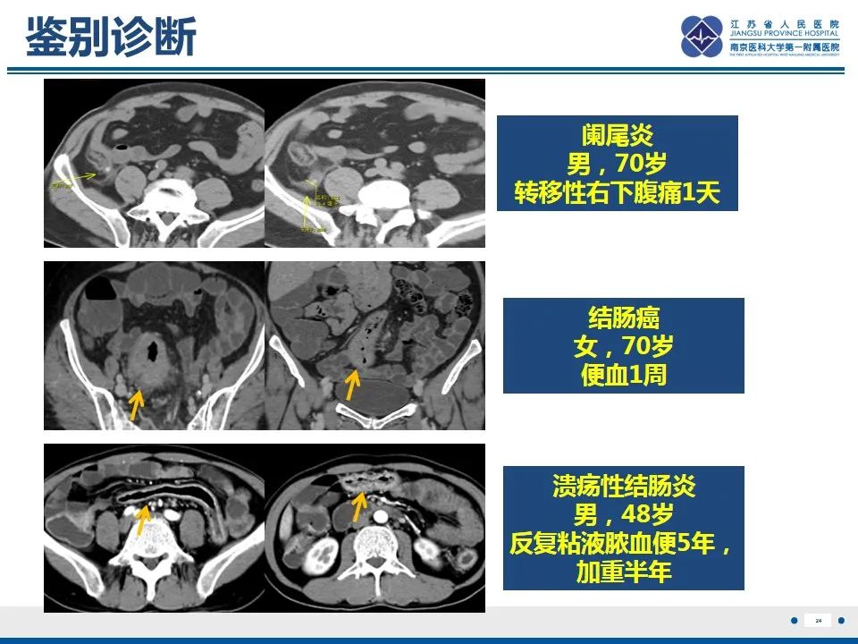 影像PPT - 【PPT】结肠憩室炎-25