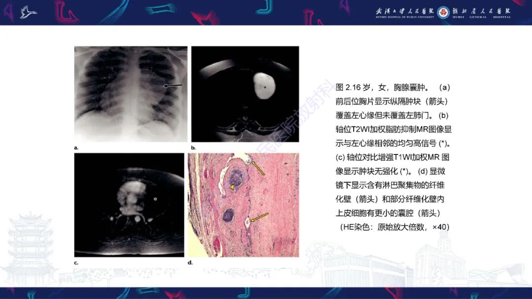 影像PPT - 【PPT】儿童纵隔占位影像诊断-9