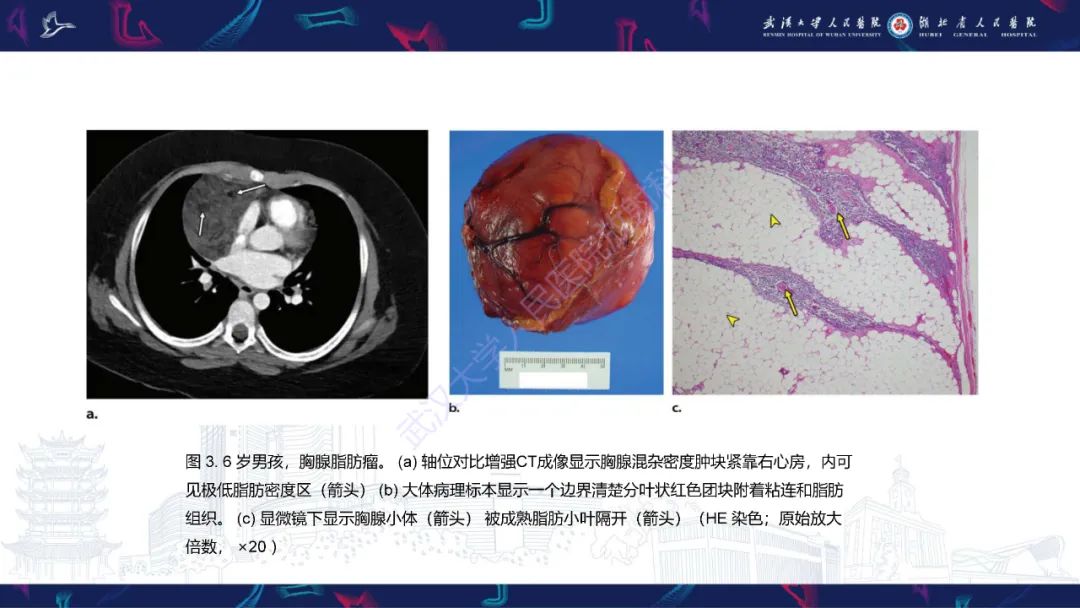 影像PPT - 【PPT】儿童纵隔占位影像诊断-11