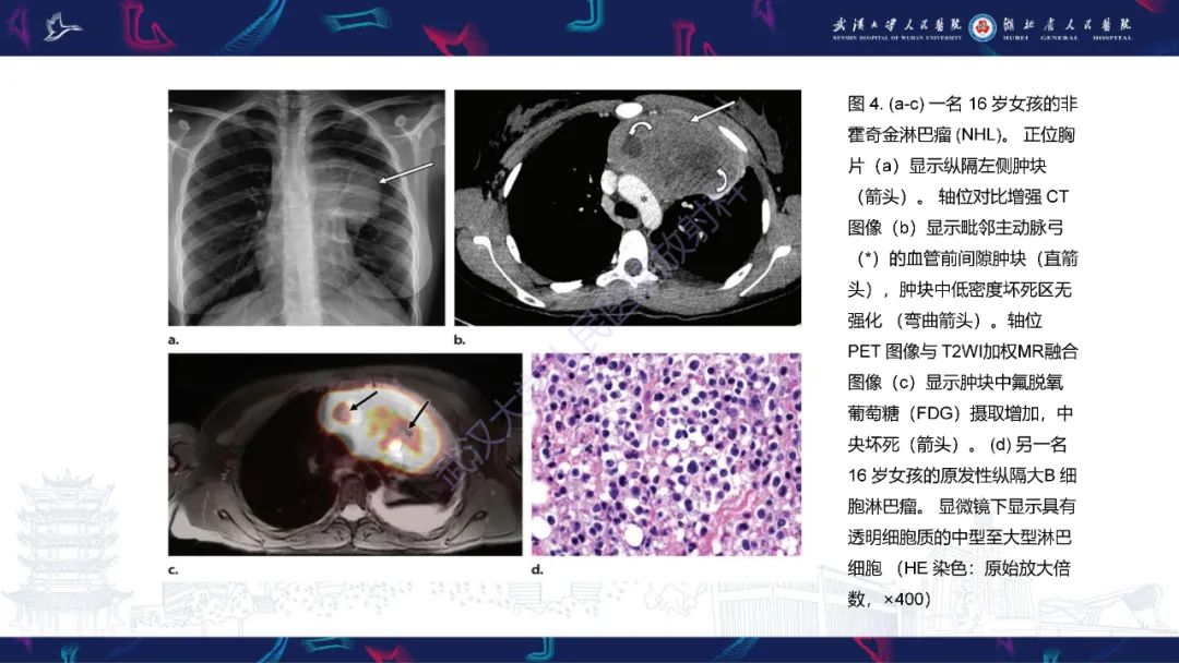 影像PPT - 【PPT】儿童纵隔占位影像诊断-14