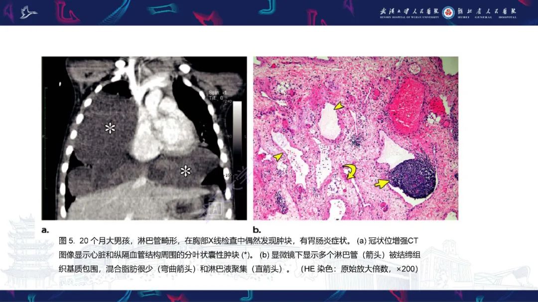 影像PPT - 【PPT】儿童纵隔占位影像诊断-17