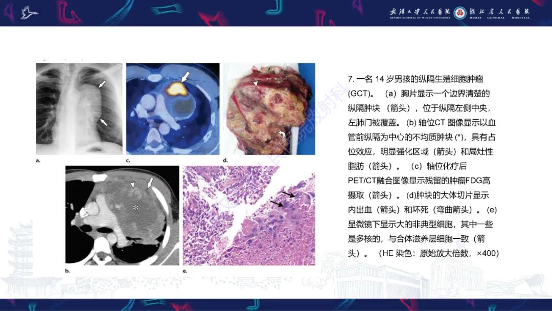影像PPT - 【PPT】儿童纵隔占位影像诊断-24