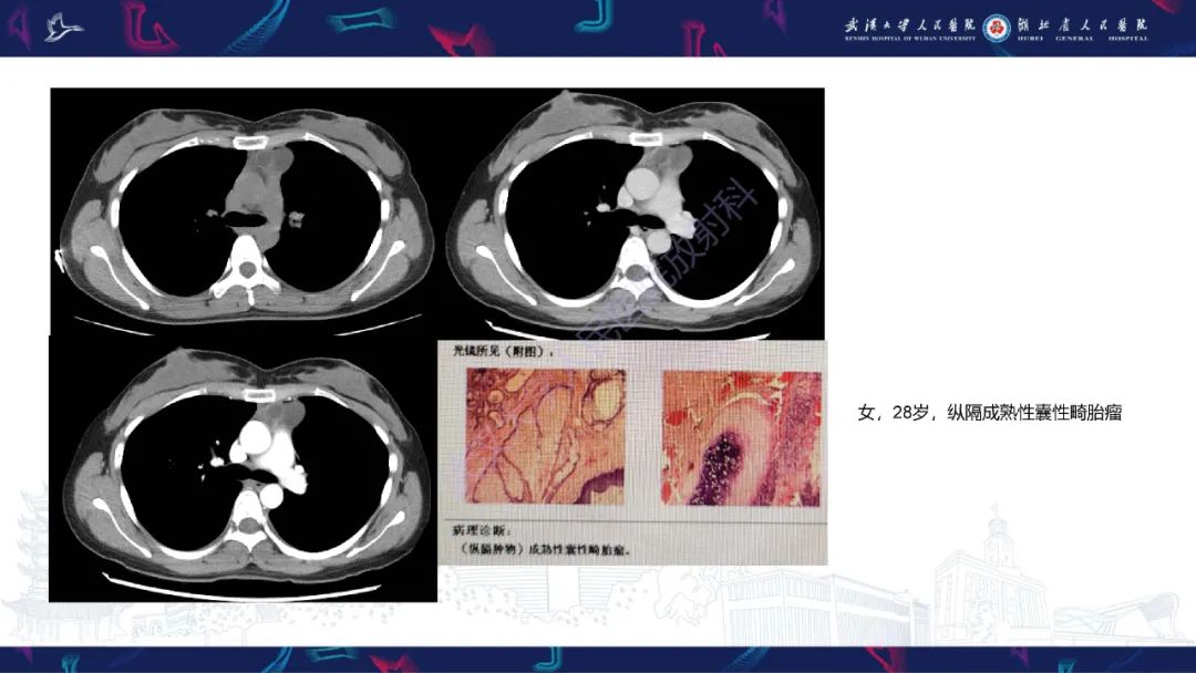 影像PPT - 【PPT】儿童纵隔占位影像诊断-25