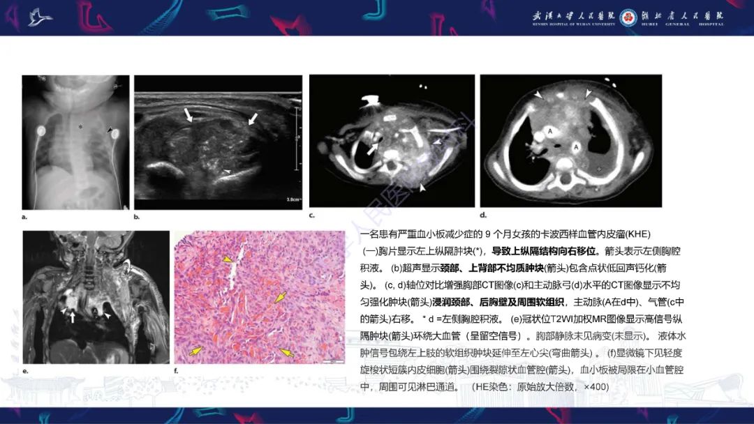 影像PPT - 【PPT】儿童纵隔占位影像诊断-21