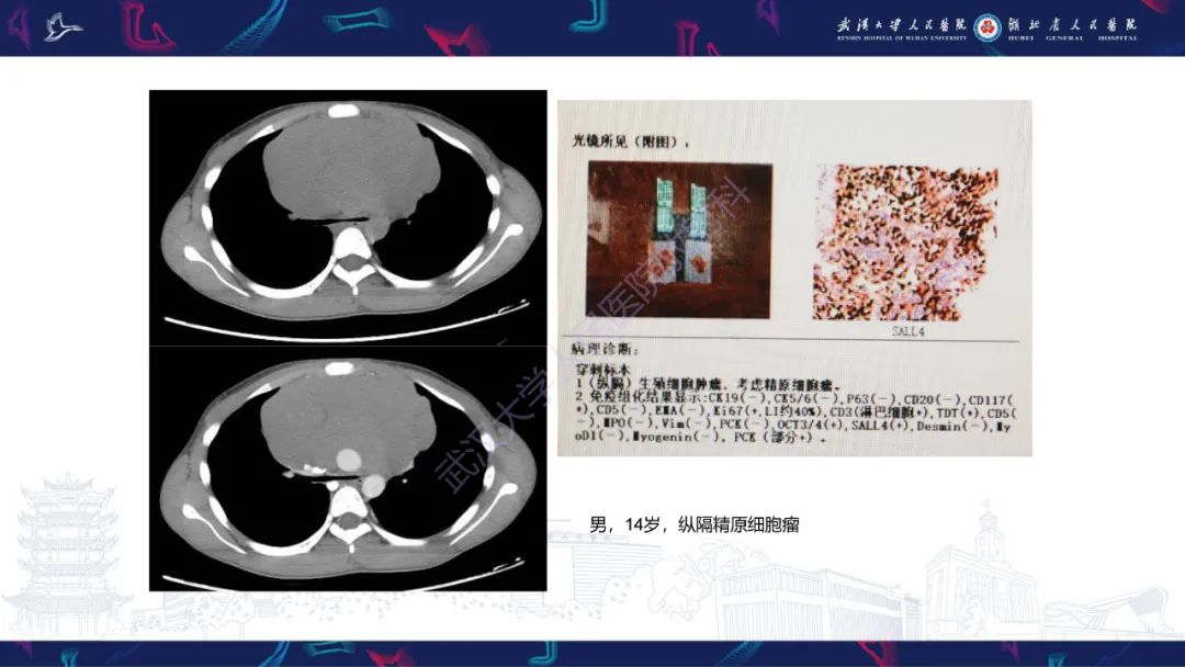 影像PPT - 【PPT】儿童纵隔占位影像诊断-26