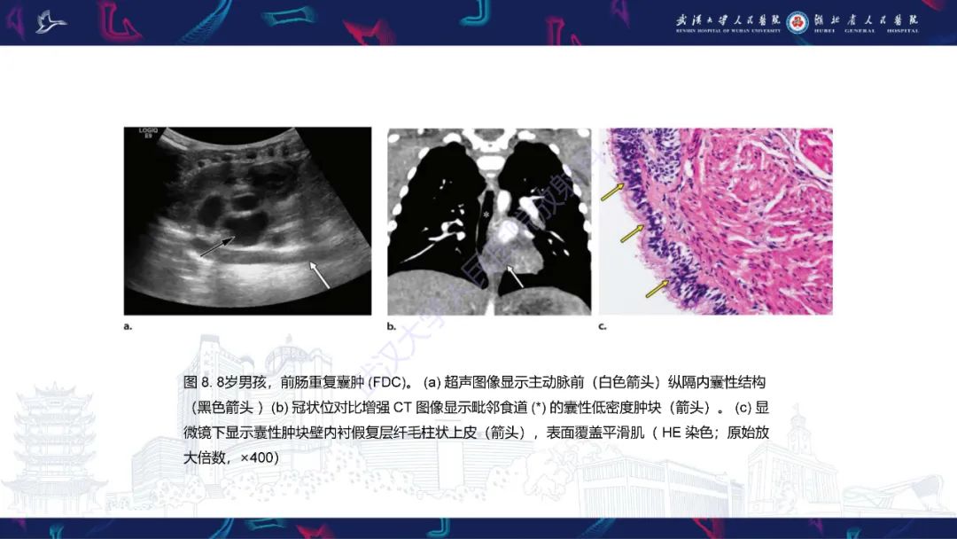影像PPT - 【PPT】儿童纵隔占位影像诊断-31