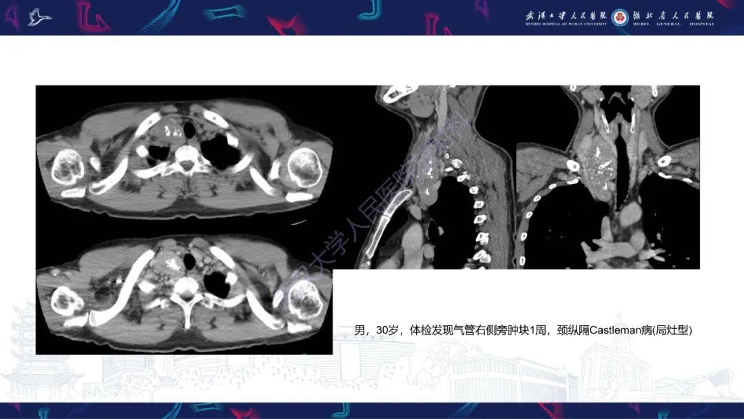 影像PPT - 【PPT】儿童纵隔占位影像诊断-36
