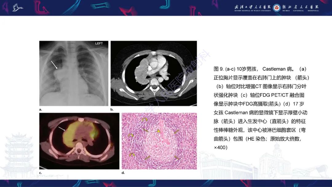 影像PPT - 【PPT】儿童纵隔占位影像诊断-35