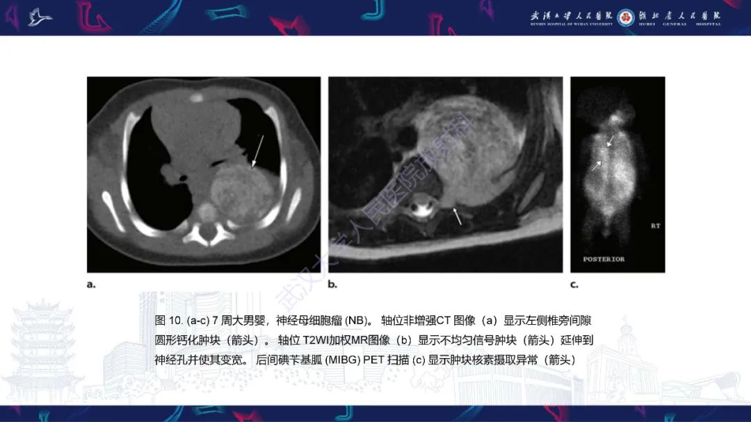 影像PPT - 【PPT】儿童纵隔占位影像诊断-45