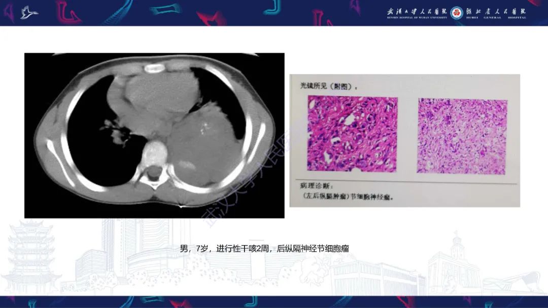 影像PPT - 【PPT】儿童纵隔占位影像诊断-47