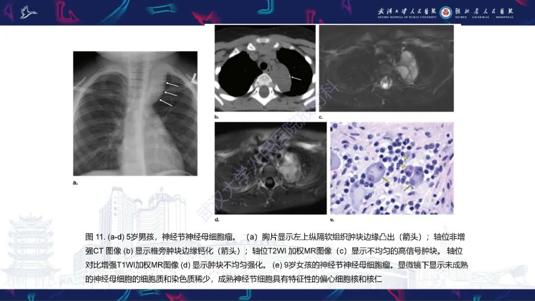 影像PPT - 【PPT】儿童纵隔占位影像诊断-46