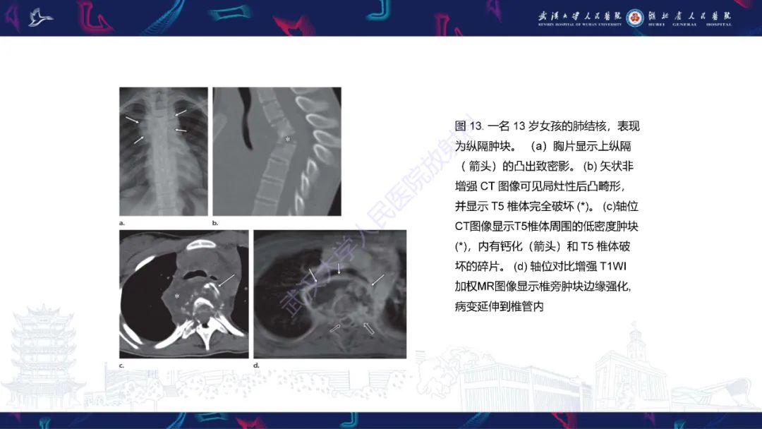 影像PPT - 【PPT】儿童纵隔占位影像诊断-52