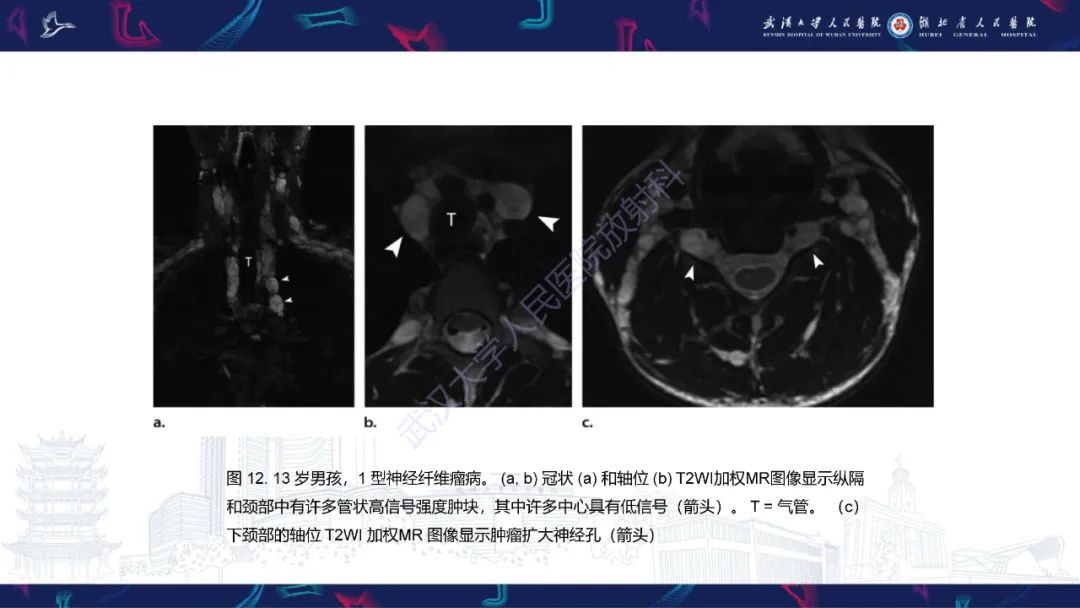 影像PPT - 【PPT】儿童纵隔占位影像诊断-50