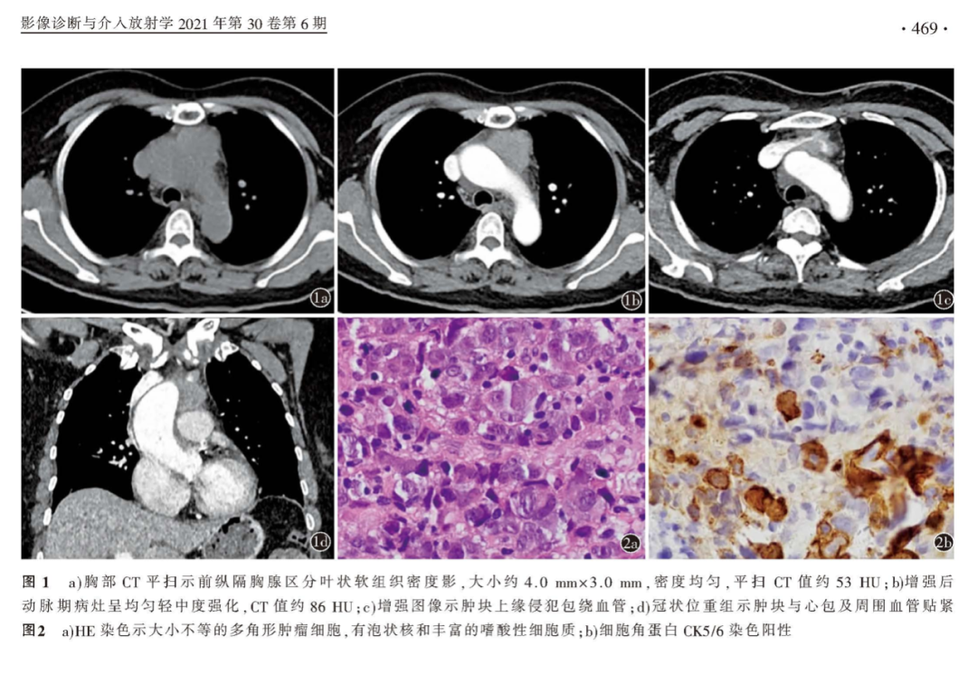影像PPT - 【病例】胸腺实质性肿瘤—胸腺癌1例的影像诊断思维-4