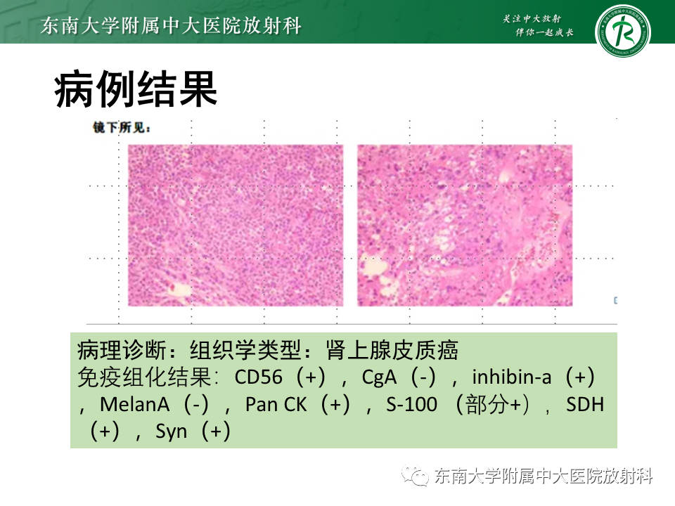 影像PPT - 【PPT】肾上腺皮质癌-4 影像PPT - 【PPT】肾上腺皮质癌-4