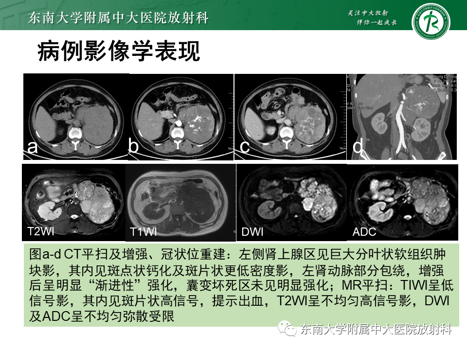 影像PPT - 【PPT】肾上腺皮质癌-3 影像PPT - 【PPT】肾上腺皮质癌-3