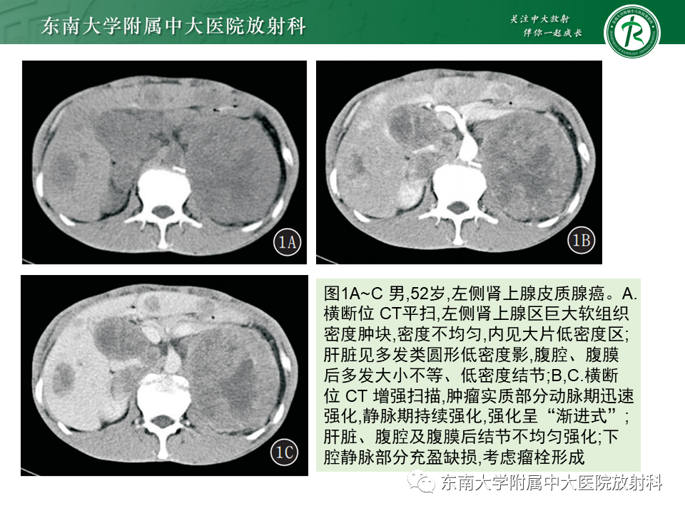 影像PPT - 【PPT】肾上腺皮质癌-14 影像PPT - 【PPT】肾上腺皮质癌-14