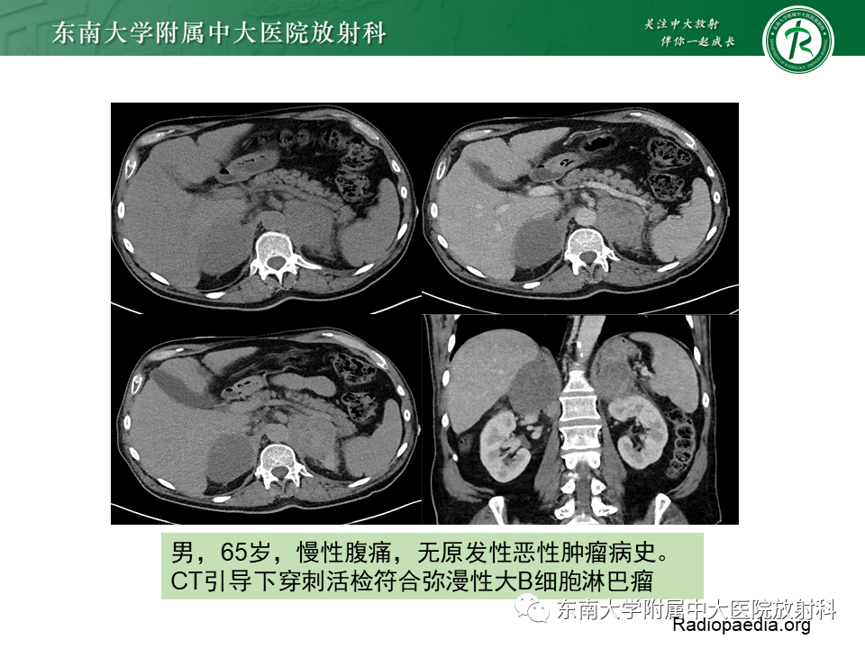 影像PPT - 【PPT】肾上腺皮质癌-22 影像PPT - 【PPT】肾上腺皮质癌-22