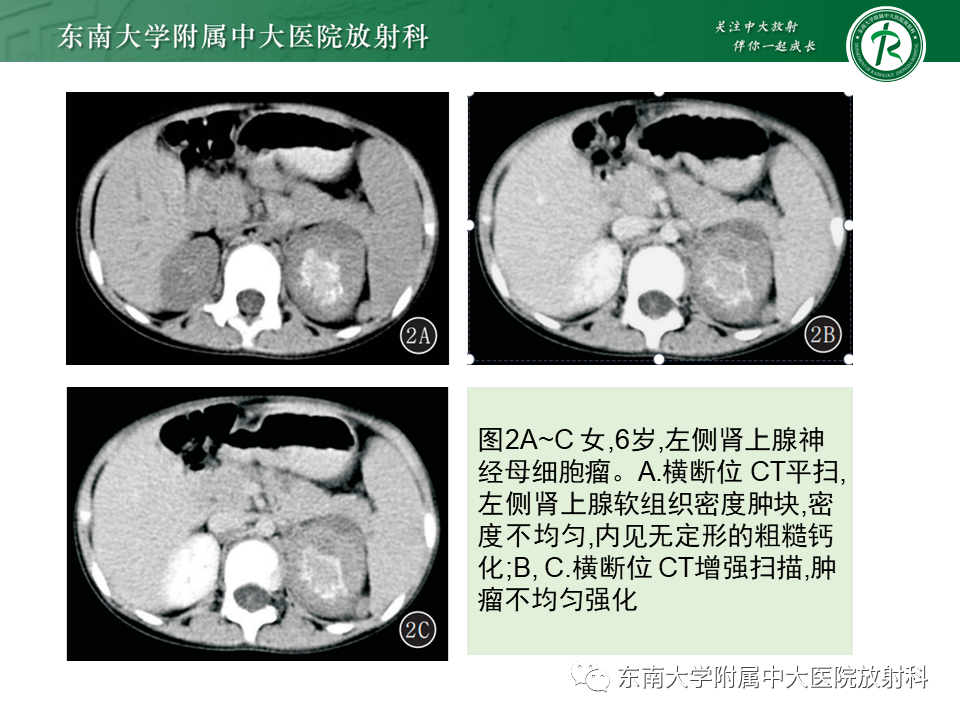 影像PPT - 【PPT】肾上腺皮质癌-24 影像PPT - 【PPT】肾上腺皮质癌-24