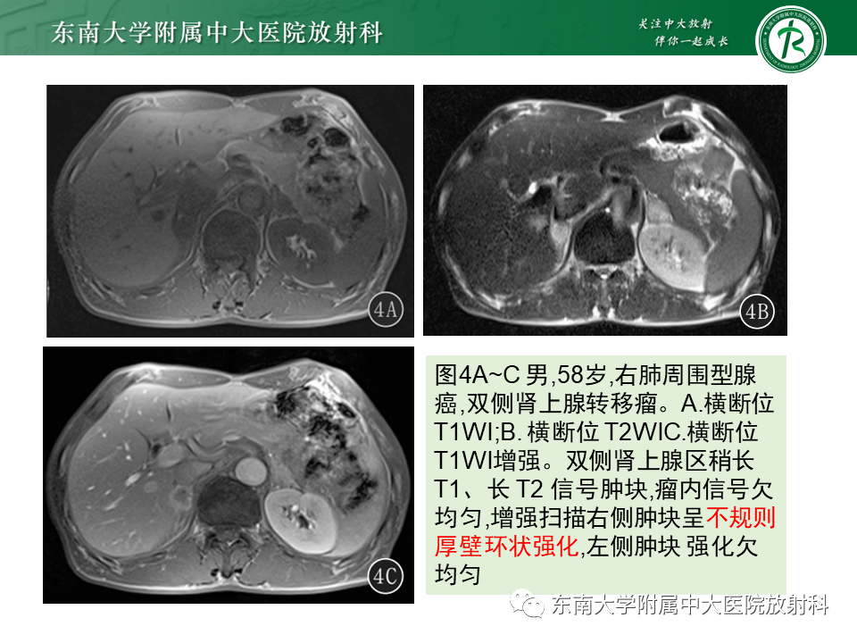 影像PPT - 【PPT】肾上腺皮质癌-27 影像PPT - 【PPT】肾上腺皮质癌-27