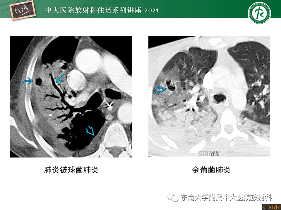影像PPT - 【PPT】非典型肺炎及其重症病例的影像表现-4