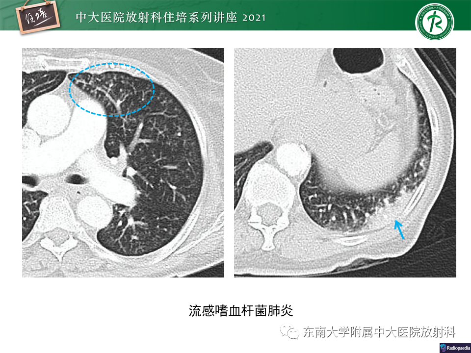 影像PPT - 【PPT】非典型肺炎及其重症病例的影像表现-5
