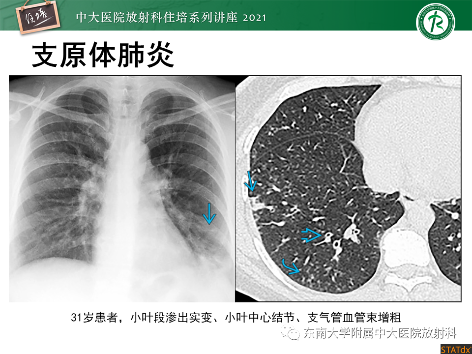 影像PPT - 【PPT】非典型肺炎及其重症病例的影像表现-11